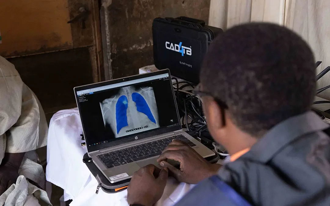 Unitaid and CHAI cut cost of AI screening software, unlocking affordable TB detection in communities without radiologists
